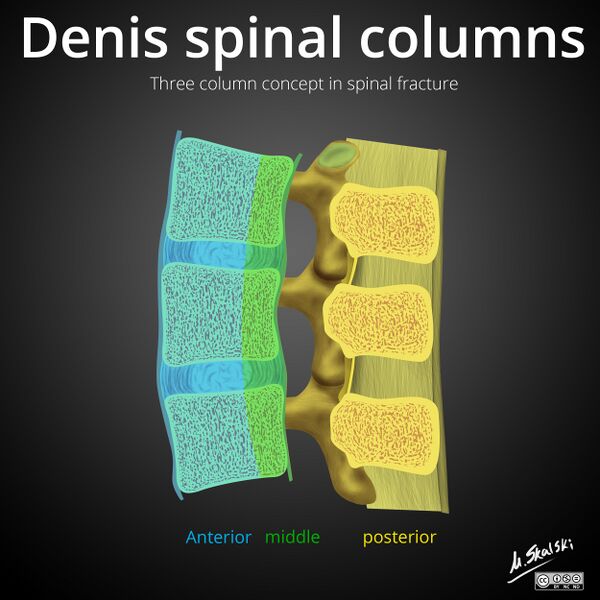 File:Denis three column concept in spinal fracture (Radiopaedia 32621).jpg