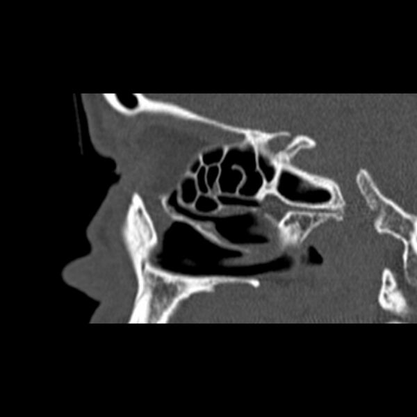 File:Nasal septal perforation (Radiopaedia 25030-25289 Sagittal bone window 46).jpg