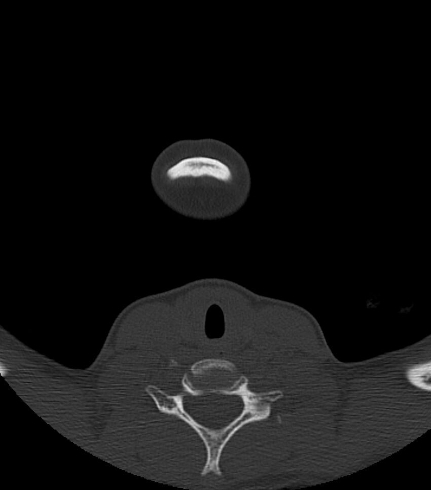 Nasoorbitoethmoid fracture (Radiopaedia 90044-107205 Axial bone window 7).jpg