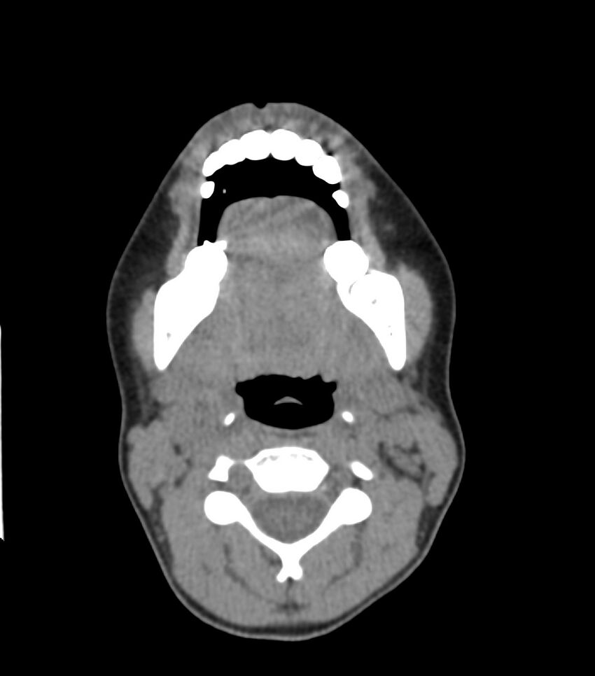 Nasoorbitoethmoid fracture (Radiopaedia 90044-107205 Axial non-contrast 69).jpg