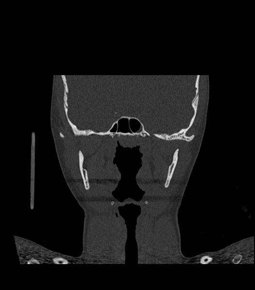 File:Nasoorbitoethmoid fracture (Radiopaedia 90044-107205 Coronal bone window 81).jpg