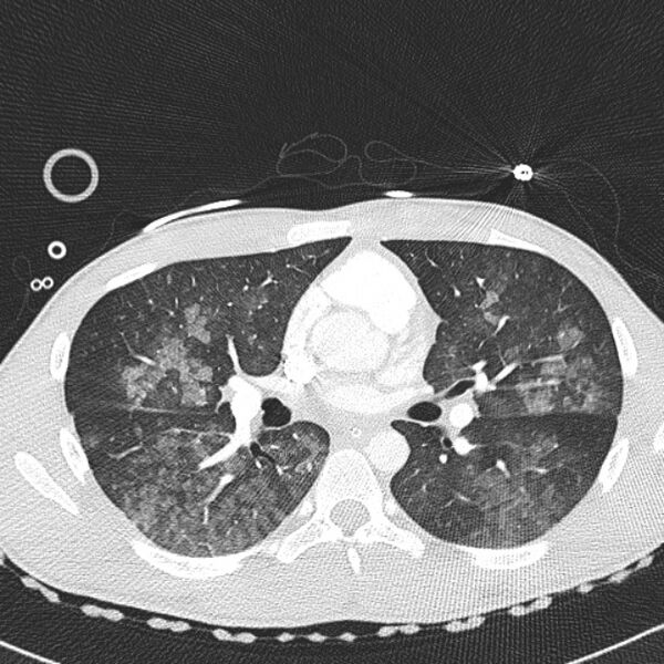 File:Near drowning (pulmonary edema) (Radiopaedia 24685-24958 lung window 26).jpg