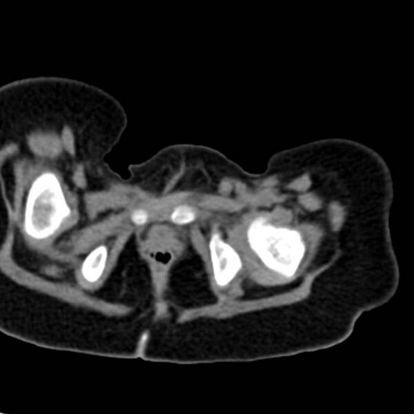File:Neuroblastoma with skull metastases (Radiopaedia 30326-30960 Axial non-contrast 63).jpg