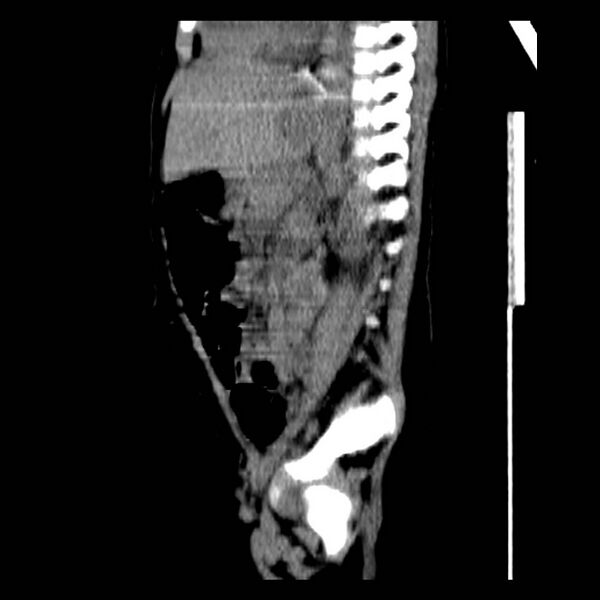 File:Neuroblastoma with skull metastases (Radiopaedia 30326-30960 B 27).jpg