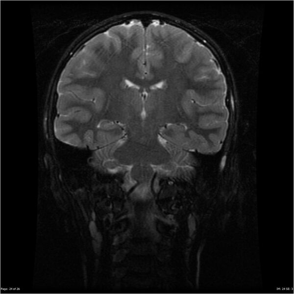 File:Neurofibromatosis type 1 (Radiopaedia 22541-22564 C 24).jpg