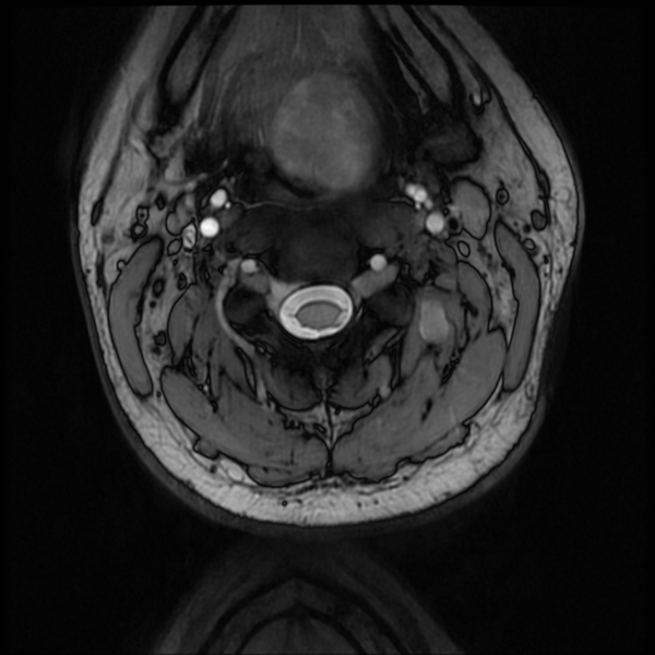 File:Neurofibromatosis type 2 (Radiopaedia 44936-48837 Axial Gradient Echo 36).png