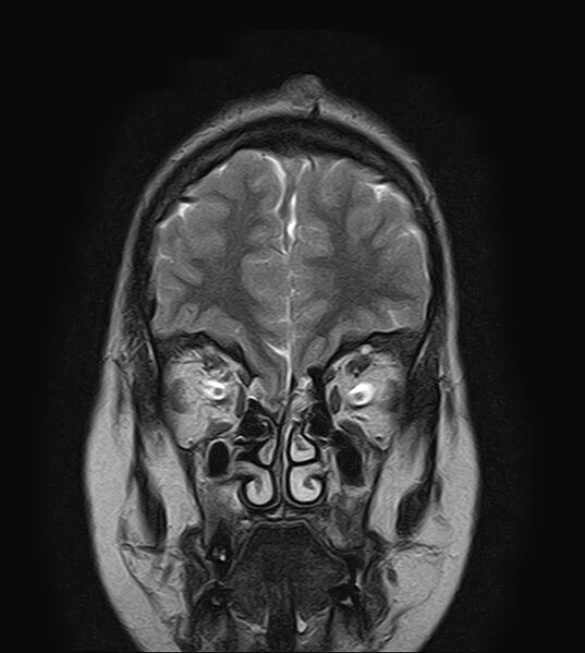 File:Neurofibromatosis type 2 (Radiopaedia 66211-75401 Coronal T2 4).jpg