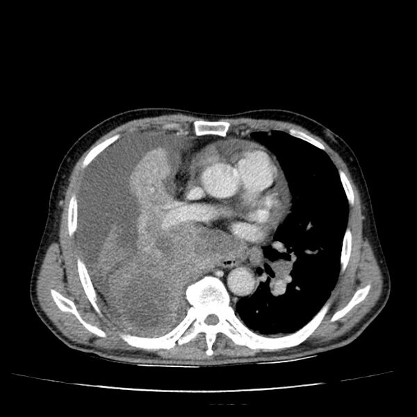 File:Non small-cell lung cancer (Radiopaedia 24467-24769 C+ delayed 32).jpg