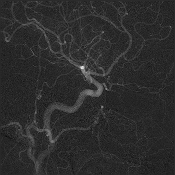 File:Normal cerebral angiogram (four vessel DSA) (Radiopaedia 41708-44649 I 9).png