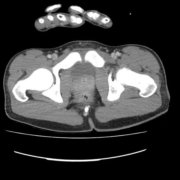 File:Normal dual-phase trauma CT chest,abdomen and pelvis (Radiopaedia 48092-52899 A 113).jpg
