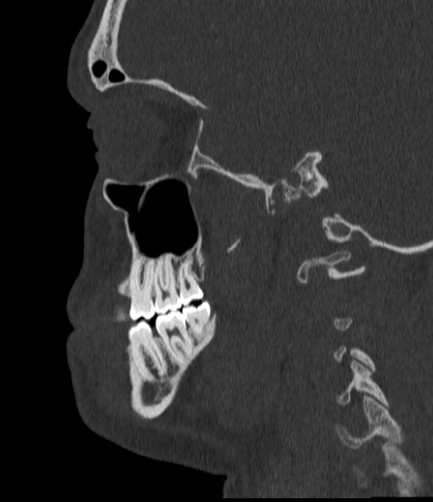 Normal facial bone CT (Radiopaedia 88742-105476 Sagittal bone window 114).jpg