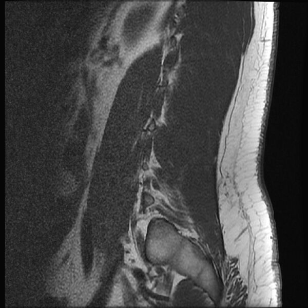 File:Normal lumbar spine MRI (Radiopaedia 43051-46311 Sagittal T1 2).jpg