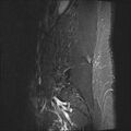 Normal lumbar spine MRI (Radiopaedia 47857-52609 Sagittal STIR 2).jpg