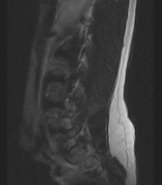 File:Normal lumbar spine MRI - low-field MRI scanner (Radiopaedia 40976-43699 Sagittal T2 2).jpg