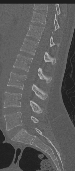 File:Normal lumbosacral CT (Radiopaedia 37923-39867 Sagittal bone window 47).png