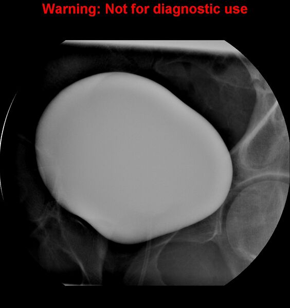 File:Normal retrograde urethrogram (RUG) and voiding cystourethrogram (VCUG) (Radiopaedia 40478-43050 VCUG 3).jpg