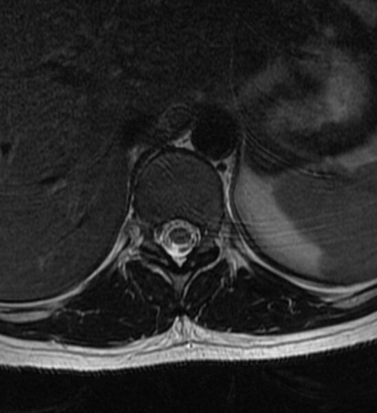 File:Normal thoracic spine MRI (Radiopaedia 41033-43781 Axial T2 20).jpg