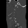 Normal trauma cervical spine (Radiopaedia 41017-43760 Sagittal bone window 5).png