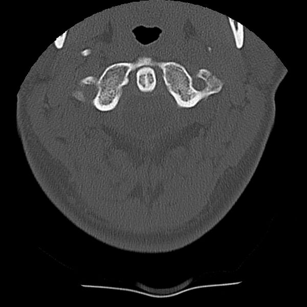 File:Normal trauma spine imaging (Radiopaedia 31753-32686 Axial bone window 10).jpg