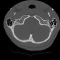 Normal trauma spine imaging (age 16) (Radiopaedia 45335-49358 Axial bone window 3).jpg