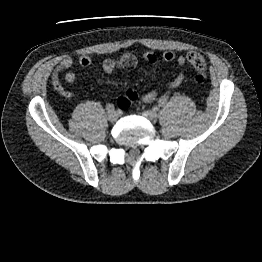 Obstructing ureteric calculus and ureteric anatomy (Radiopaedia 62730-71042 Axial non-contrast 109).jpg