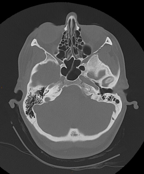 File:Occipital condyle fracture (Radiopaedia 61165-69056 Axial bone window 19).jpg