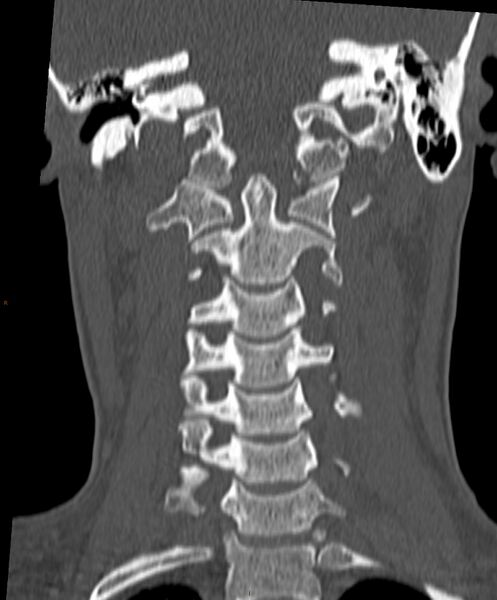 File:Occipital condyle fracture (Radiopaedia 61165-69056 Coronal bone window 8).jpg