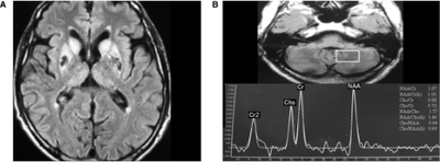 a)High signal caudate and lenticular nuclei b) long echo time in deep left cerebellum