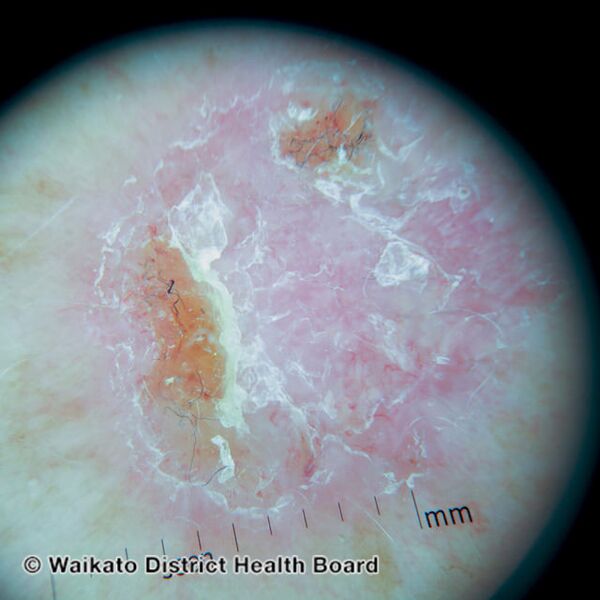 File:Superficial basal cell carcinoma dermoscopy (DermNet NZ sbcc-arm-wdhb).jpg