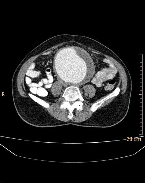 File:Abdominal aortic aneurysm (Radiopaedia 25985-26121 Axial C+ arterial phase 24).jpg