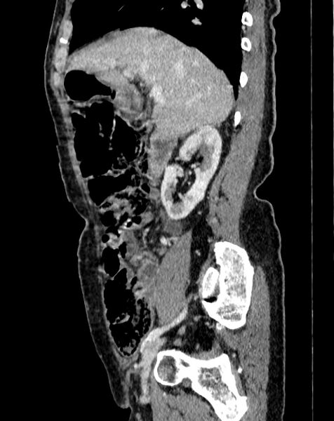 File:Abdominal aortic aneurysm (Radiopaedia 83581-98689 Sagittal C+ portal venous phase 7).jpg