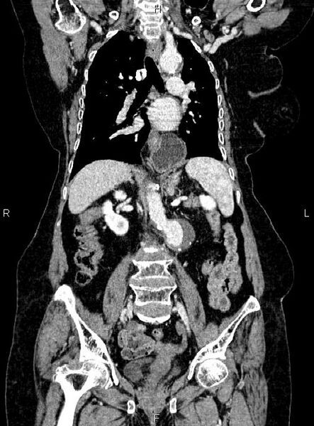 File:Abdominal aortic aneurysm (Radiopaedia 85063-100606 Coronal C+ arterial phase 32).jpg