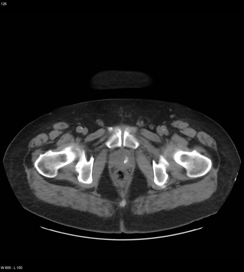 Abdominal aortic aneurysm with intramural hematoma then rupture (Radiopaedia 50278-55631 Axial non-contrast 122).jpg