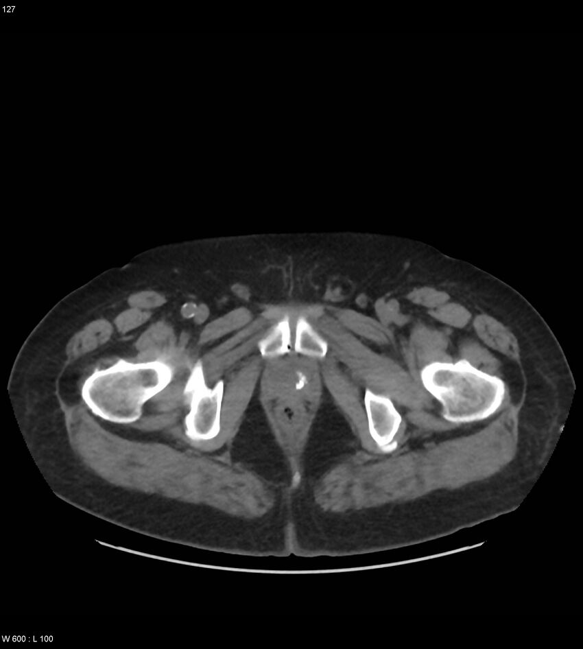 Abdominal aortic aneurysm with intramural hematoma then rupture (Radiopaedia 50278-55631 Axial non-contrast 123).jpg