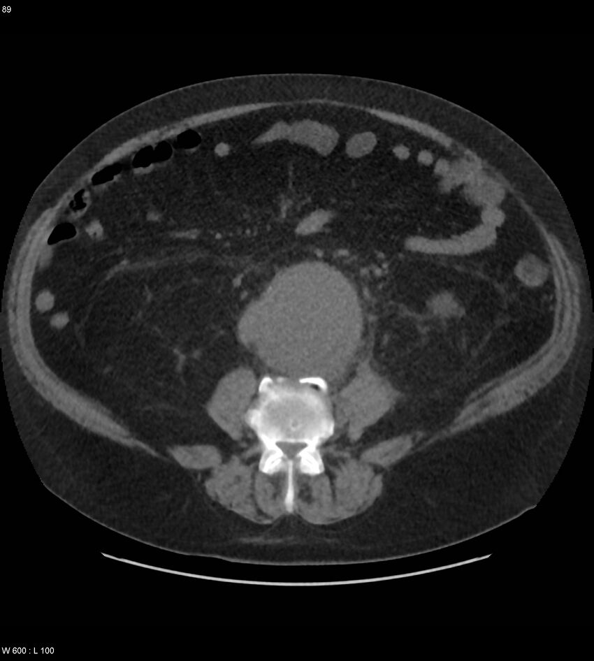 Abdominal aortic aneurysm with intramural hematoma then rupture (Radiopaedia 50278-55631 Axial non-contrast 85).jpg