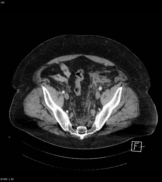 File:Abdominal aortic aneurysm with intramural hematoma then rupture (Radiopaedia 50278-55632 Axial C+ arterial phase 141).jpg