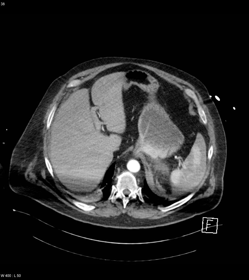 Abdominal aortic aneurysm with intramural hematoma then rupture (Radiopaedia 50278-55632 Axial C+ arterial phase 37).jpg