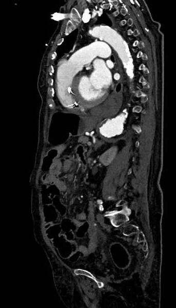 File:Abdominal aortic aneurysm with thrombus fissuration (Radiopaedia 73192-83919 Sagittal C+ arterial phase 53).jpg