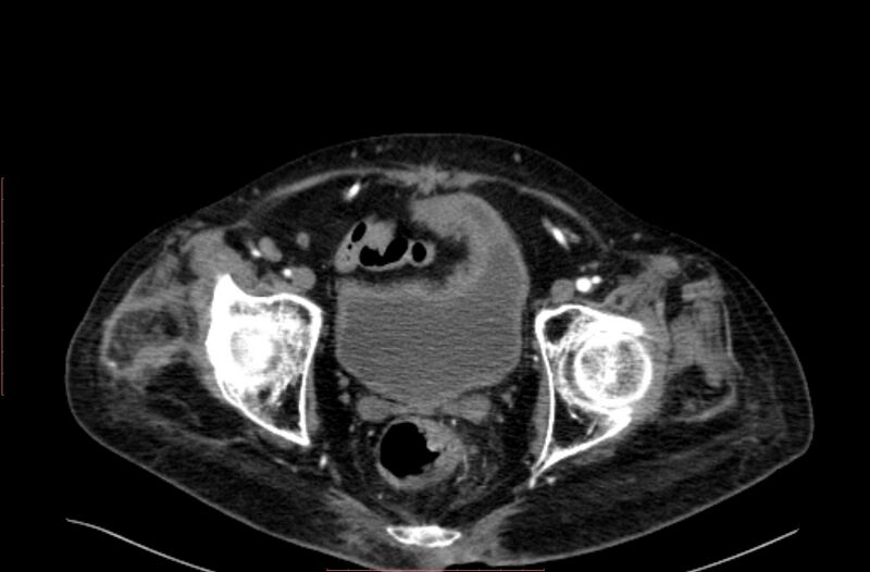 File:Abdominal aortic interposition tube graft and aneurysm thrombosis (Radiopaedia 71438-81857 Axial C+ arterial phase 218).jpg