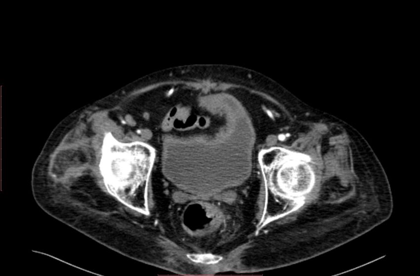 Abdominal aortic interposition tube graft and aneurysm thrombosis (Radiopaedia 71438-81857 Axial C+ arterial phase 218).jpg