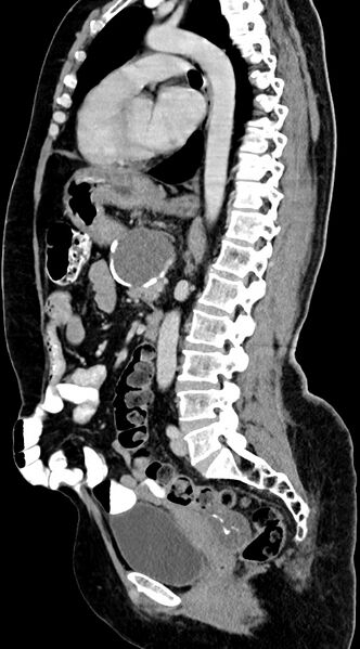 File:Abdominal hydatid disease (Radiopaedia 68223-77737 Sagittal C+ portal venous phase 32).jpg