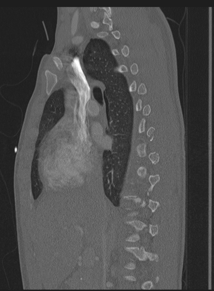 File:Abdominal multi-trauma - devascularised kidney and liver, spleen and pancreatic lacerations (Radiopaedia 34984-36486 Sagittal bone window 46).png