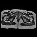 Abdominal wall endometriosis (Radiopaedia 83702-98847 Axial T2 17).jpg