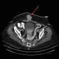 Abdominal wall recurrence after colorectal resection for cancer (Radiopaedia 23444-23524 A 1).jpg