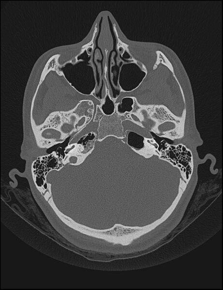 File:Aberrant right internal carotid artery (Radiopaedia 65191-74198 Axial non-contrast 40).jpg