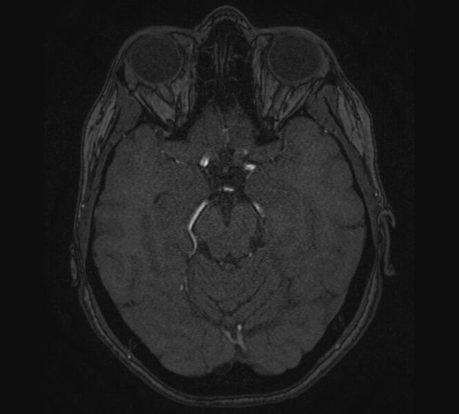 File:Accessory middle cerebral artery and ICA aneurysm (Radiopaedia 22656-22674 MRA 42).jpg