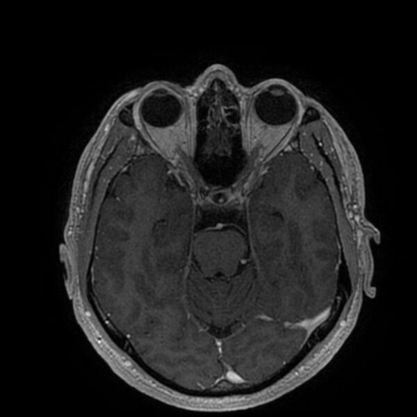File:Acoustic schwannoma - intracanalicular (Radiopaedia 37247-39024 Axial T1 C+ 97).jpg