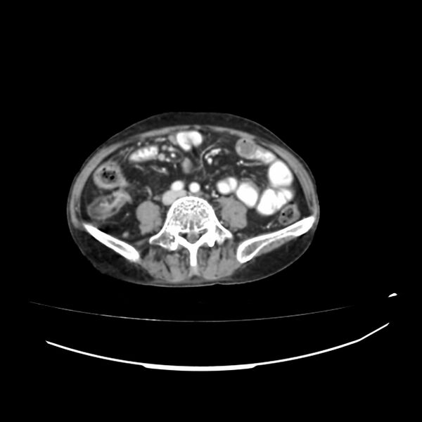 File:Acute-on-chronic Crohn disease with enteroenteric fistula (Radiopaedia 66686-75987 B 22).jpg