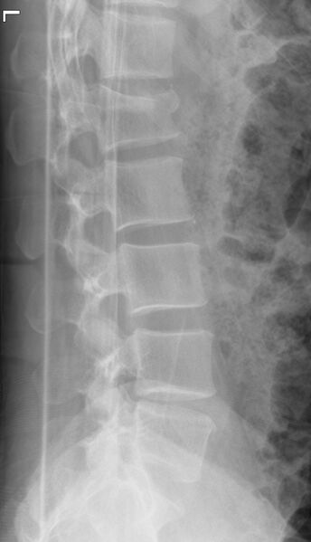 File:Acute L1 burst compression fracture (Radiopaedia 34430-35754 Lateral 1).JPG
