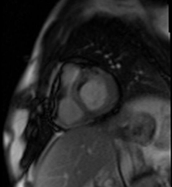 File:Acute anteroseptal myocardial infarction (Radiopaedia 68409-77945 Short axis (basal) Perfusion 27).jpg
